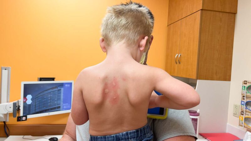 tree nut allergy testing at hospital on toddler boy